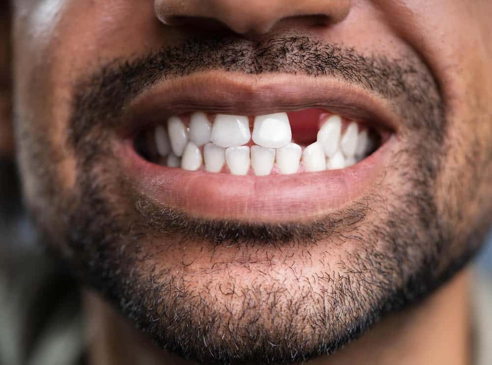 missing tooth
