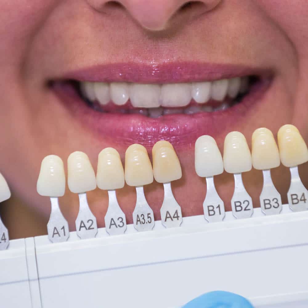 teeth discoloration help